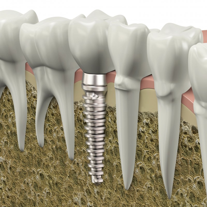 Dental Implants In St. Augustine FL Offer Advantages And Disadvantages