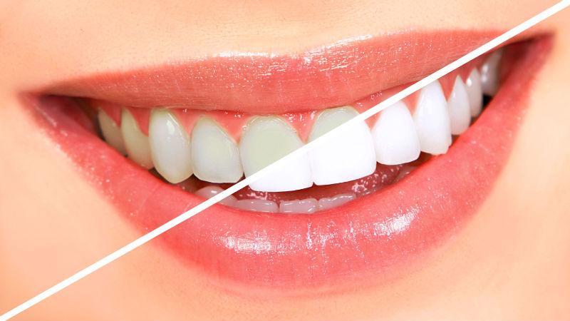 Benefits of Opting for a Professional Whitening System Service