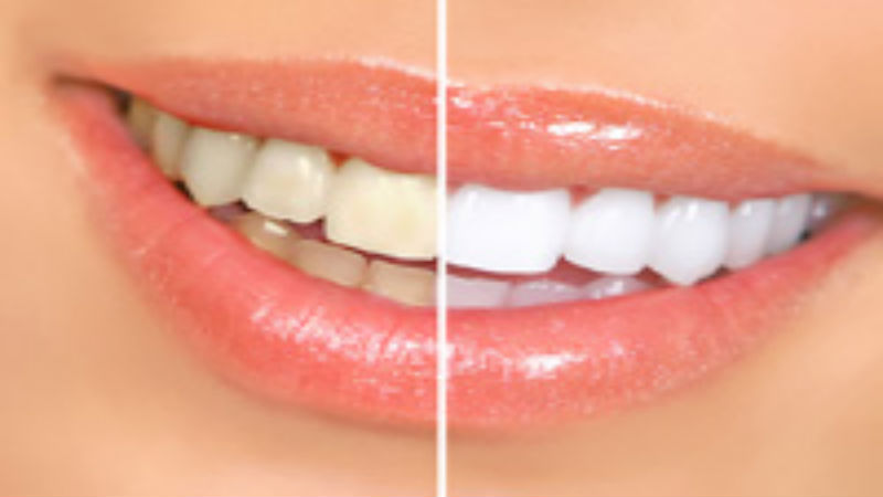 What To Expect When You Have Your Teeth Professionally Cleaned