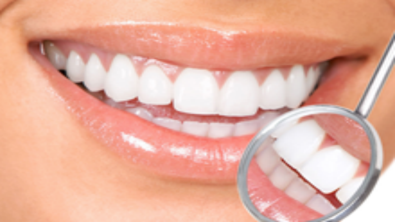 Everything You Need to Know About Dental Veneers