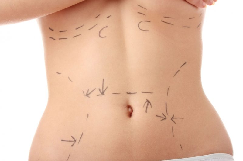 A Chicago Tummy Tuck Can be Your Solution for a Better Body!