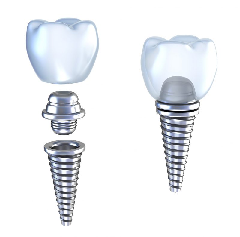 How Dental Implants can Improve Your Overall Health