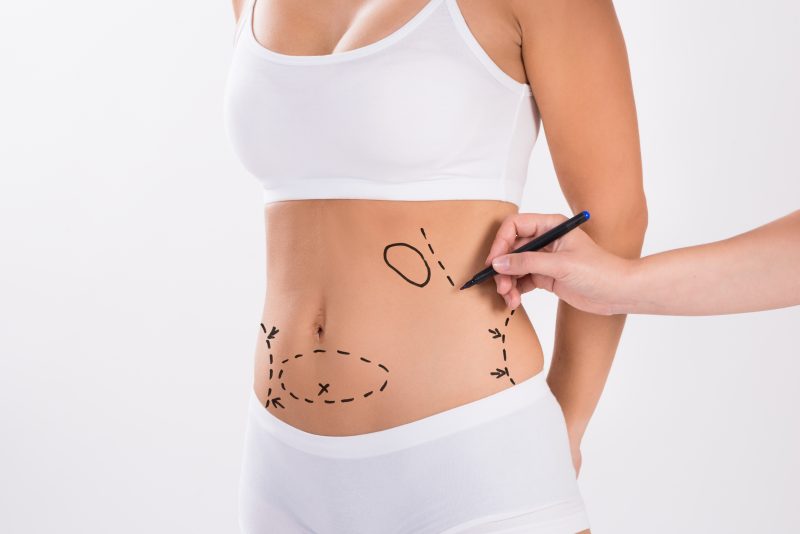 A Mommy Makeover is an Incredible Procedure, Consult with a Chicago Cosmetic Surgeon for More Information
