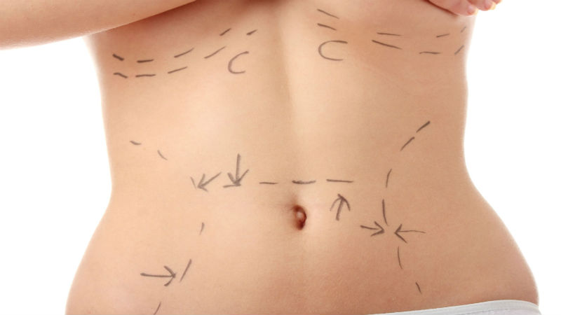 Important Facts to Know Before You Get Liposuction Surgery in Chicago